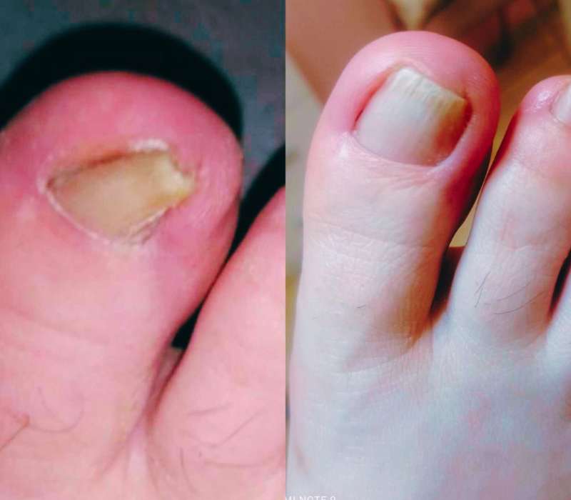 θεραπεία ονυχομυκητίασης με laser epagelmaties.com.gr