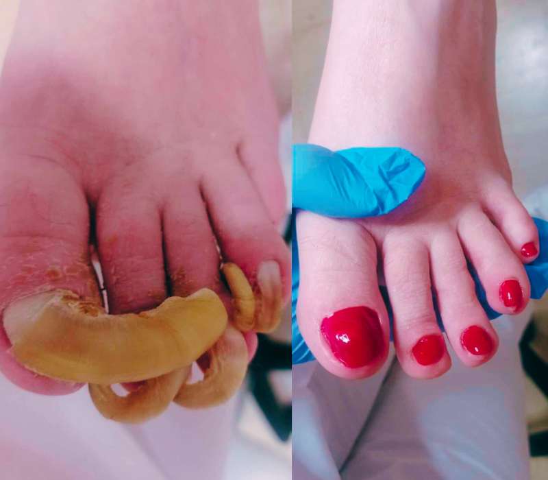 κλινικός καθαρισμός ποδιών epagelmaties.com.gr