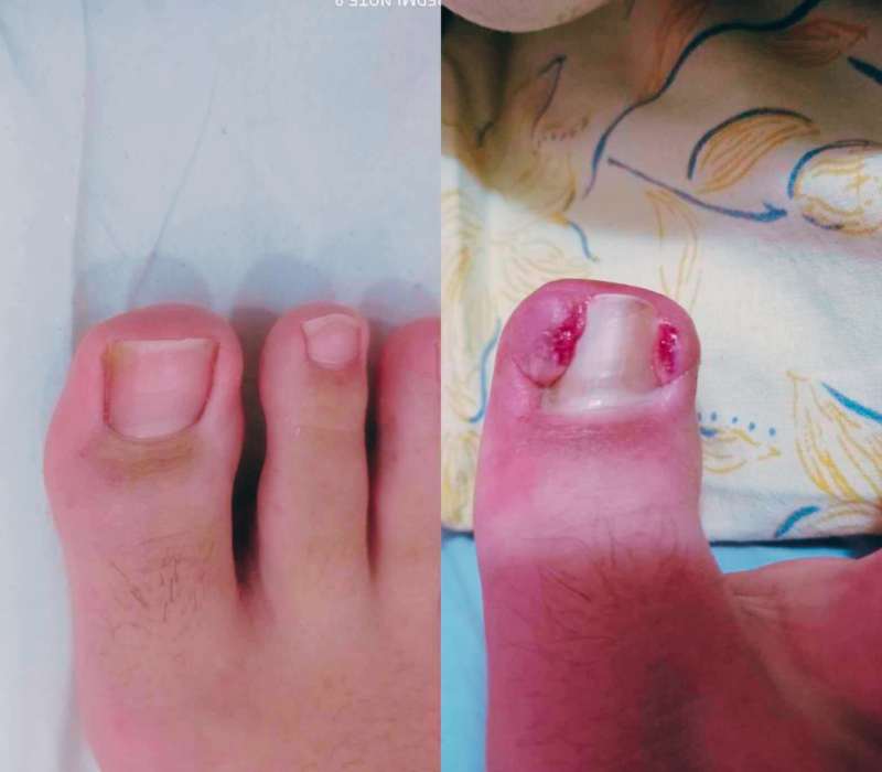 ορθονυχία για είσφρυση και ονυχοκρύπτωση epagelmaties.com.gr