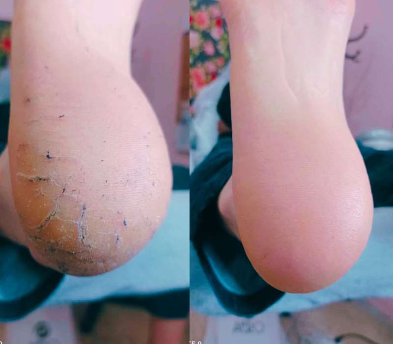 πελματογράφημα και ορθωτικά πέλματα ΑμεΑ FRIENDLY